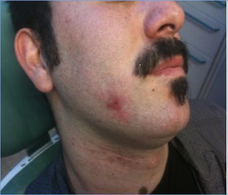 Non-healing wound on the right cheek