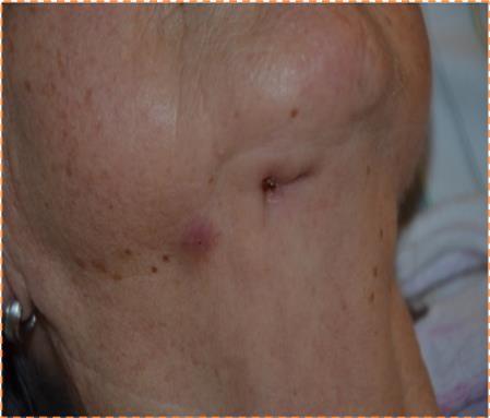 Chronic infection and fistula on the right submental/submandibular side