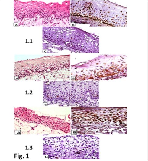 Photomicrographs showing (a. x 100) Hematoxylin and Eosin (H&E) and immunohistochemical staining of (b. x 400) p16INK4a and (c. x 400) Ki-67. 1.1. CIN I, a, H&E staining. b, diffuse (one-third) p16INK4a immunostaining. c, scattered Ki-67 immunostaining in CIN 1; 1.2. CIN 2. a, H&E staining. b, diffuse nuclear and cytoplasmic (two-third) p16INK4a immunostaining. c, scattered Ki-67 immunostaining in CIN 2; 1.3. CIN 3. a, H&E staining. b, diffuse nuclear and cytoplasmic (above two-third) p16INK4a immunostaining. c, scattered Ki-67 immunostaining in CIN 3.
