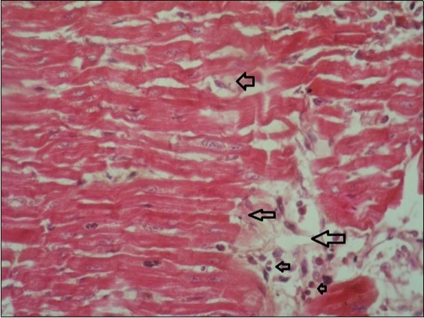heart (dead cattle less than 1 year old) showed vesicular nuclei of myocytes which suffering hydropic degeneration. Some inflammatory cells (neutrophils, esinophils, lymphocytes) substitute an area of necrosis inside myocardium bundles (arrows). (H &E, X 40)