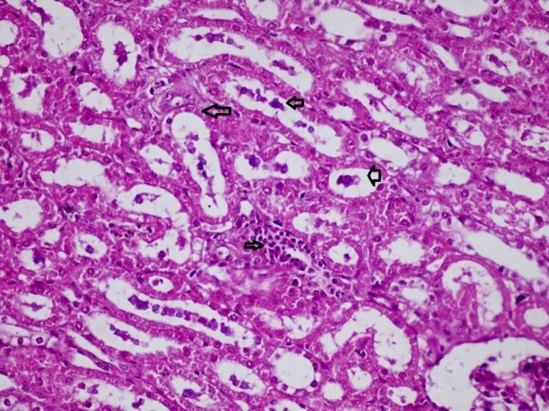 kidneys (dead cattle less than 1 year old) showed severe hydropic degeneration of renal tubular epithelium accompanied by dilated renal tubules, vesicles formations and casts (arrows). (H&E, X 60)