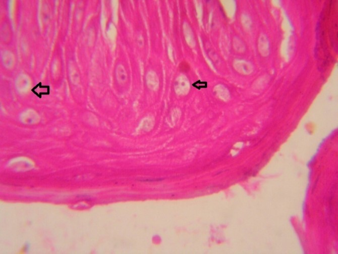Tongue (dead cattle less than 1 year old) showed vesicular nuclei of stratum corium epithelium which suffering hydropic degeneration. Esinophlic intranuclear inclusions were seen surrounded by hallow zone(arrows). (Hematoxylin and fuchsin X 60)