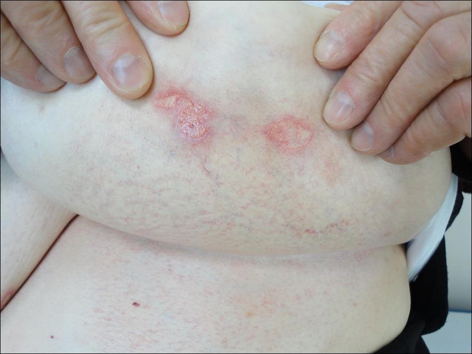 Case three: Mild erythema, mild cutaneous atrophy, fine telangiectases and superficial punched out ulcers with erythematous clear bases located in the inframamarian region on the left side.
