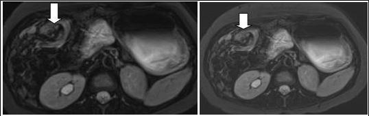 Axial contrast-enhanced MRI scans show characteristic whirpool appearance of bowel and mesentery wrapping around superior mesenteric artery