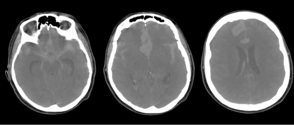 Non-contrast axial CT scan showing thick subarachnoid hemorrhage in the basal cisterns and in the frontal interemispheric space