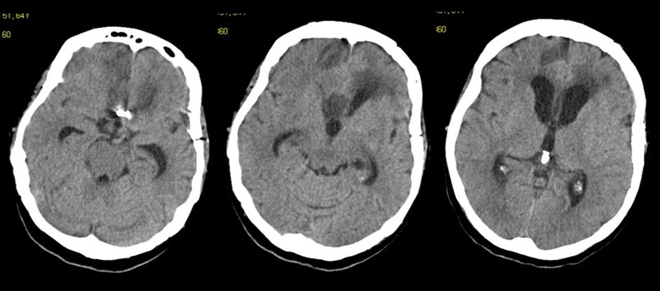 Follow-up at 6 weeks. The vascular clip is in place. Ventricles are quite enlarged. The region of the corpus callosum appears altered