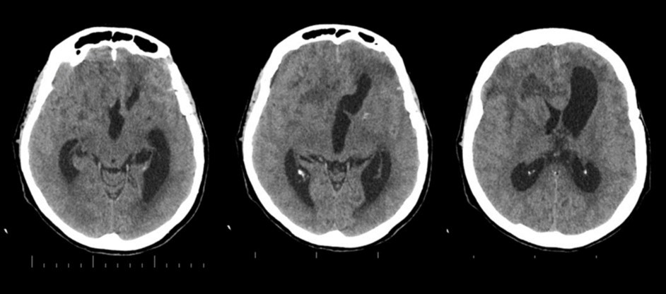 4 months non-contrast CT scan. Ventricles are dilated. A mass clearly affects the right frontal and midline region
