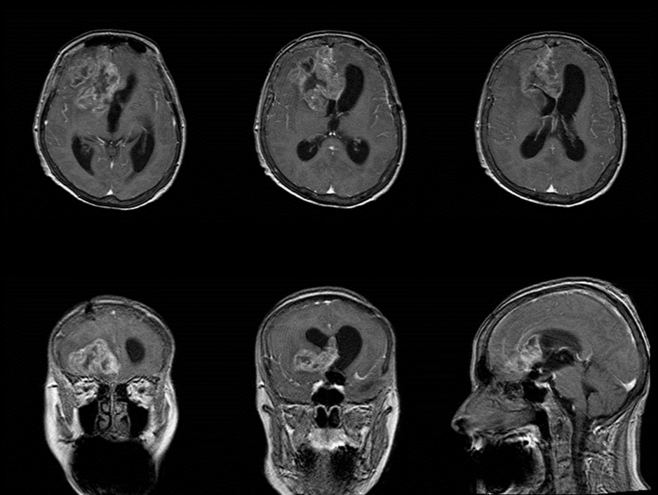 Pre-operative contrast axial, coronal and sagittal MRI. Glioma of the right frontal lobe, extending contralaterally