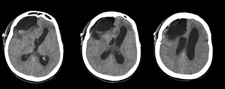 Post-operative non-contrast CT scan. Subtotal removal of the tumor, sparing the corpus callosum area. Partial relieve of mass effect on the ventricles, that remains enlarged