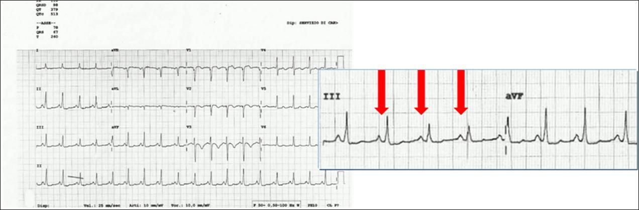 Sinus tachycardia and ventricular pre excitation