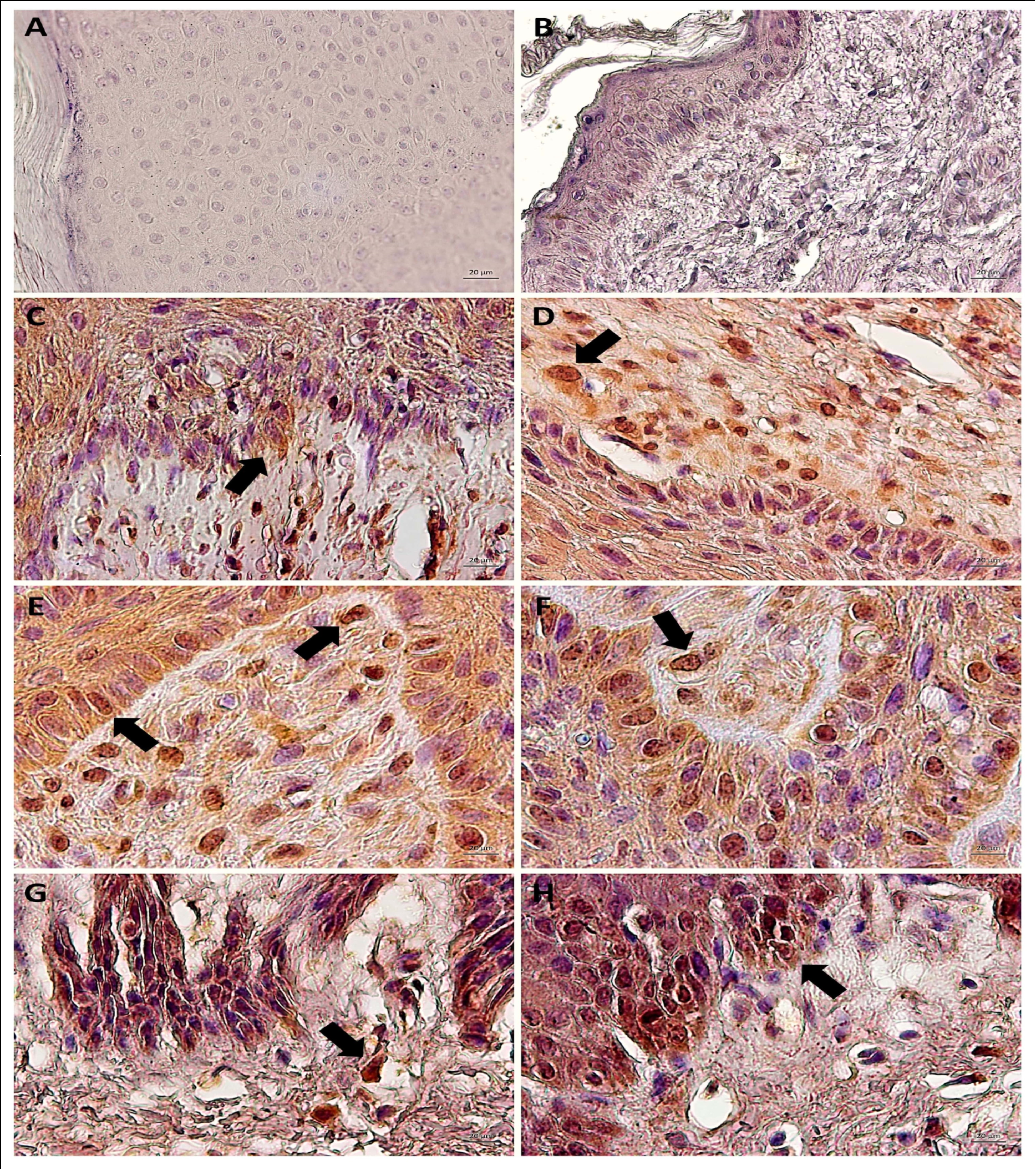 Immunodetection of STAT3 Y705 (active) showing the absence of expression in negative control (A, cutaneous papilloma incubated exclusively with secondary antibody) and BPV-free normal skin (B). Results show the aberrant nuclear immunodetection of STAT3 Y705 cutaneous papilloma (C and D, papilloma 01), fibropapilloma (E and F - papilloma 02 and 03, respectively) and esophageal carcinoma (G and H). The STAT3 Y705 expression was verified in keratinocyte-like cells present into the dermis. Images obtained using objectives of 10X (A, B, C and G) and 20X (D, E, F and H).