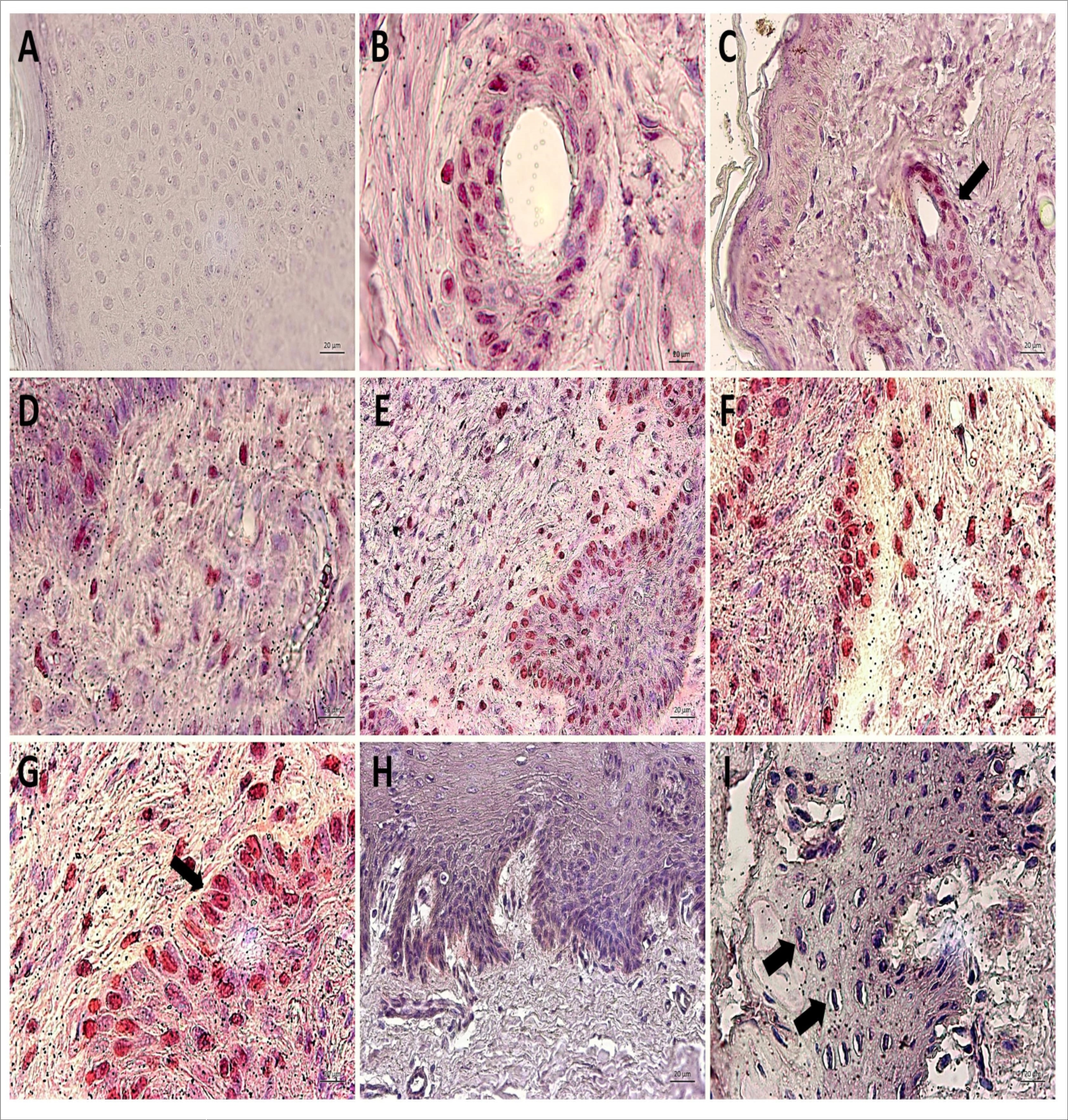 Immunodetection of Oct-3/4 showing the absence of expression of this nuclear transcription factor in negative control (A, cutaneous papilloma incubated exclusively with secondary antibody) and the Oct-3/4 expression restricted to cells of hair follicle (pointed by the arrow) and some basal keratinocytes of BPV-free normal skin, as expected (B and C). However, the results show an aberrant nuclear immunodetection of Oct-3/4 in both epidermis and dermis of cutaneous papilloma, including in depolarized basal keratinocytes (arrow) (D, papilloma 01) and fibropapilloma (E – papilloma 02 and F-G – papilloma 03). It was not verified the Oct-3/4 expression in esophageal carcinoma (H and I). This result can be attributed to the high mitogenic activity observed in this tissue, which was verified by the presence of mitotic cells (arrow) (I). Images obtained using objectives of 5X (C, E and H), 10X (A, D, F and I) and 20X (B and G).