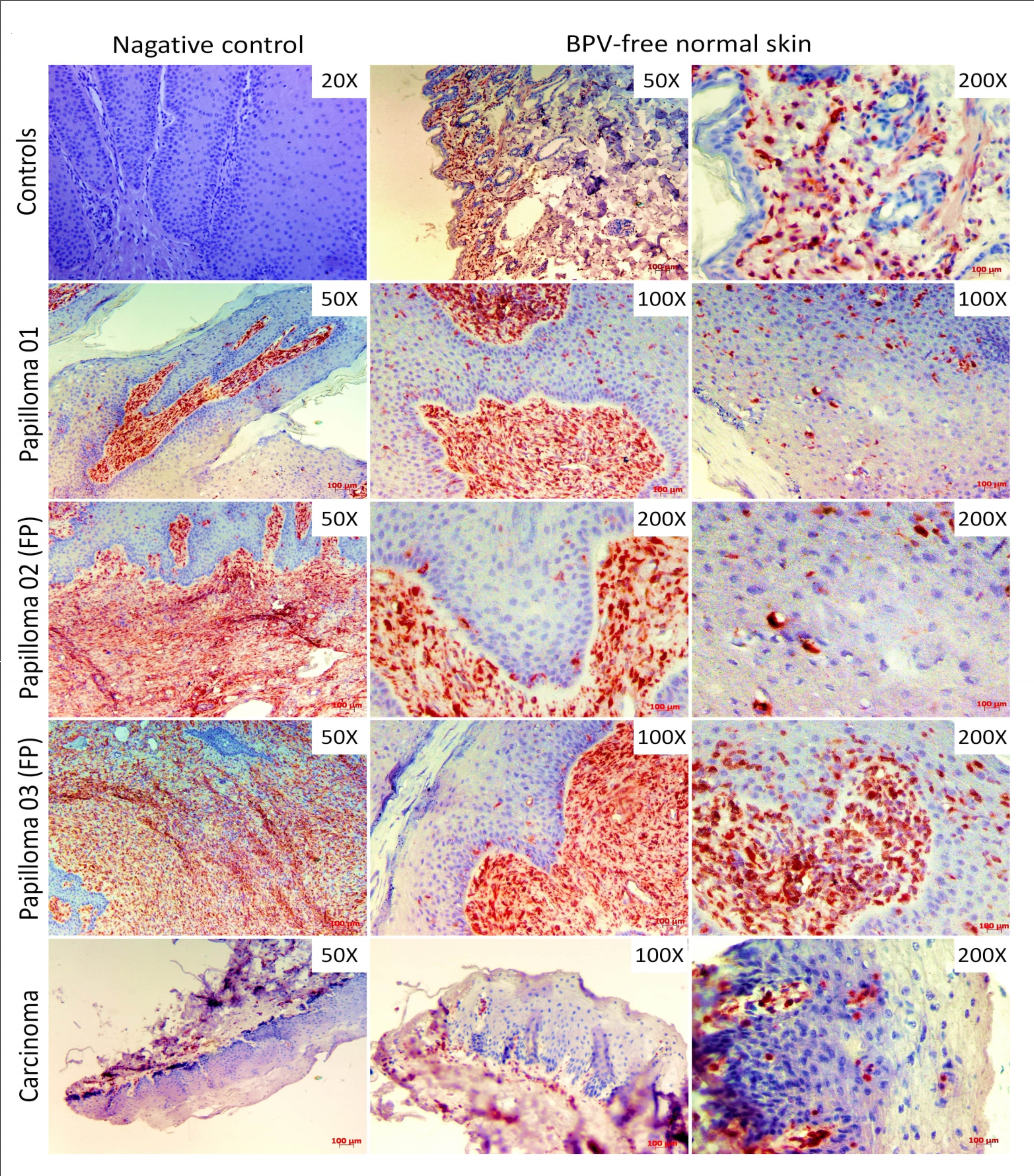 Immunodetection of vimentin showing the absence of labeling in negative control (cutaneous papilloma incubated exclusively with secondary antibody) and the protein expression into the dermis of BPV-free normal skin, but not in the epithelium. Results show the vimentin immunodetection in both dermis, as expected, and epidermis of all BPV-infected lesions, including esophageal carcinoma. It is verified the vimentin expression in koilocytes and fibroblastoid keratinocytes present in dermoepidermal junction and suprabasal layer.