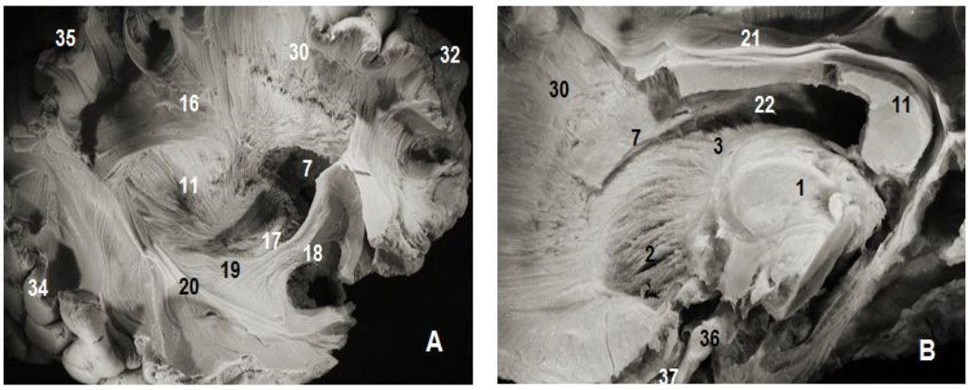 Subependymal stratum: (A) lateral view of right hemisphere and (B) medial view of left hemisphere. 1.Thalamus, 2. Anterior thalamic radiation, 7. Subependymal substratum, 4. Ependymal membrane, 6. Lateral ventricle, 11. Splenium of corpus callosum, 21. Cingulum, 30. Corona radiata, 32. Parietal pole, 33. Frontal pole, 35. Occipital pole, 36 tract optic