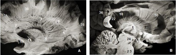 Thalamic radiations: (A) lateral view and (B) medial view. 1. Thalamus, 2. Anterior thalamic radiations, 3. Superior thalamic radiations, 4. Posterior thalamic radiations, 5. Inferior thalamic radiations, 6. Ventricular landmark, 10. Tapetum of corpus callosum, 11. Splenium of corpus callosum, 22. Ependymal membrane, 23 .Pons , 24. Mesencephalon, 17. Optic tract, 18. Uncinate fasciculus, 31. Occipital pole, 36. Cerebellum, 37.Frontal pole.