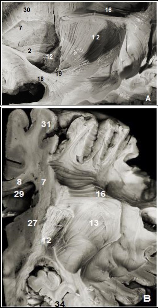 (A) Lateral view of left cerebral hemisphere after dissection and (B) coronal view. 2. Anterior thalamic radiation, 7. Subependymal stratum, 8. Corpus callosum, 12. Internal capsule, 13. External capsule, 13. SLF, 15. Corona radiata, 16. Uncinate fasciculus, 19. Inferior frontal occipital fasciculus, 27. Putamen, 28. Globus pallidus, 29. lateral ventricle, 31. Parietal pole, 34. Temporal pole.