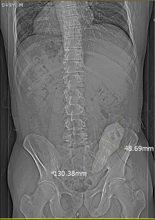 Preoperative CT scan