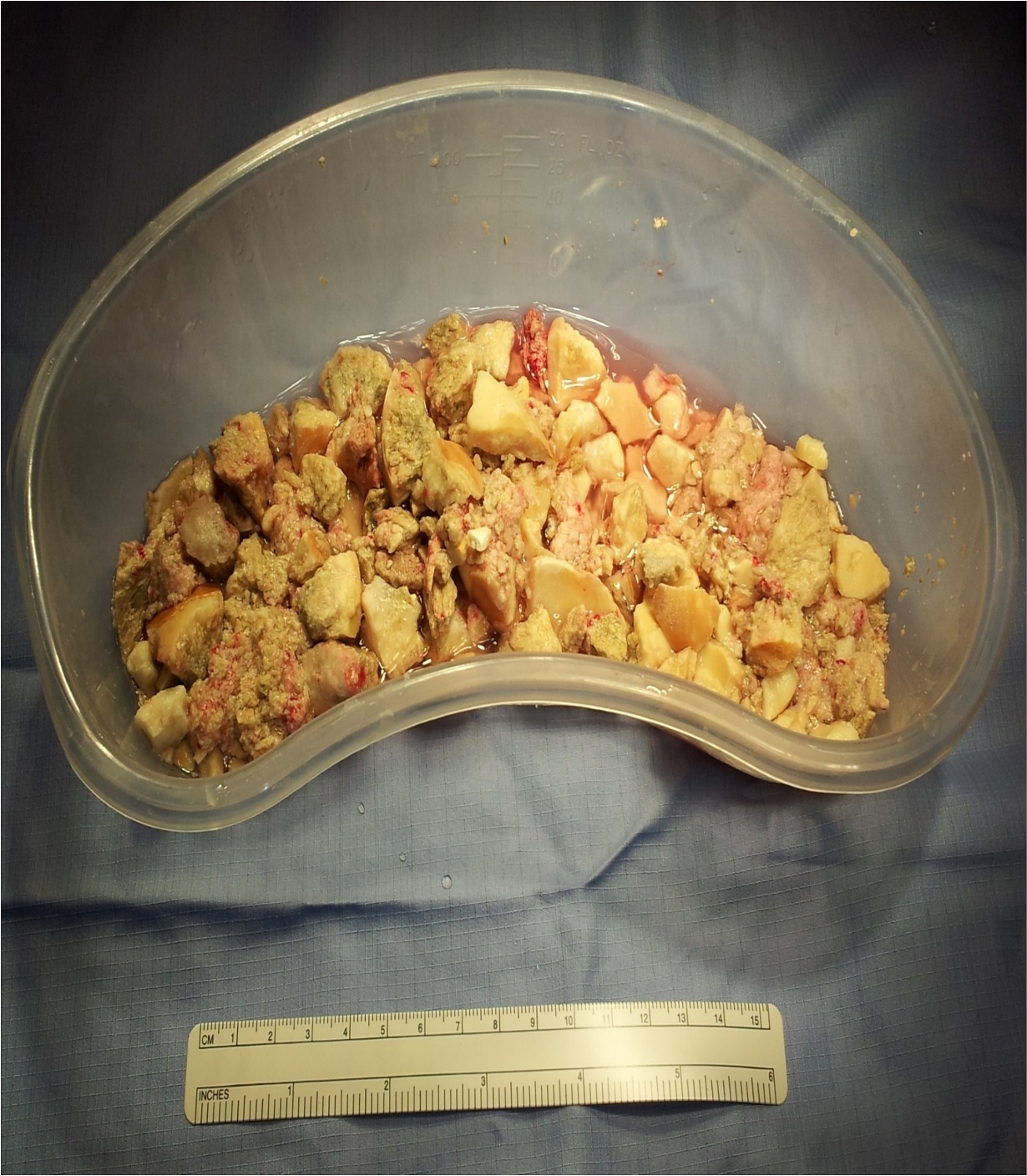 Conduit stone fragments