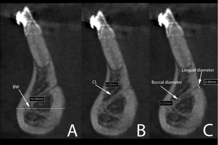 Cross-sectional views show the lingual canal. Images (A), (B) and (C) show the measurement of bone width (BW, the longest distance in the anterior mandibles under the lingual canal), canal length (CL) and lingual canal diameter (buccal and lingual), respectively.