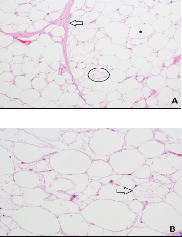 Histopathology of lipomatous mass. A. Hematoxylin and eosin stain (10X) demonstrates fibrous septae (arrow), mature white adipocytes (*), and multivacuolated brown fat cells (circle). B. Hematoxylin and eosin stain (20X) demonstrates several multivacuolated brown fat cells (arrow) with granular eosinophilic cytoplasm.