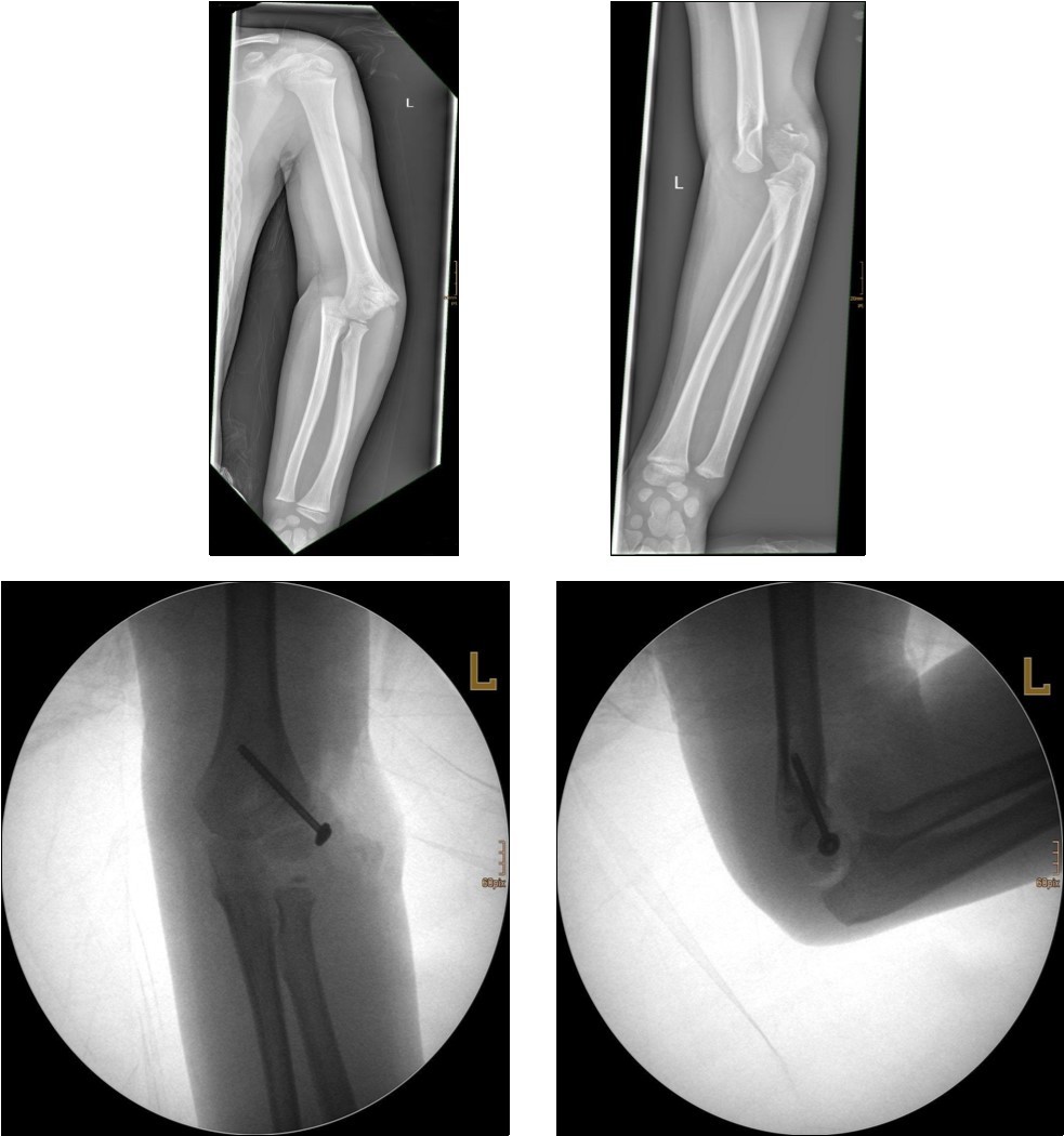 9 year old male patient with a elbow dislocation and a dislocated left lateral condyle fracture which was treated by open reduction and osteosynthesis with a screw (personal collection)