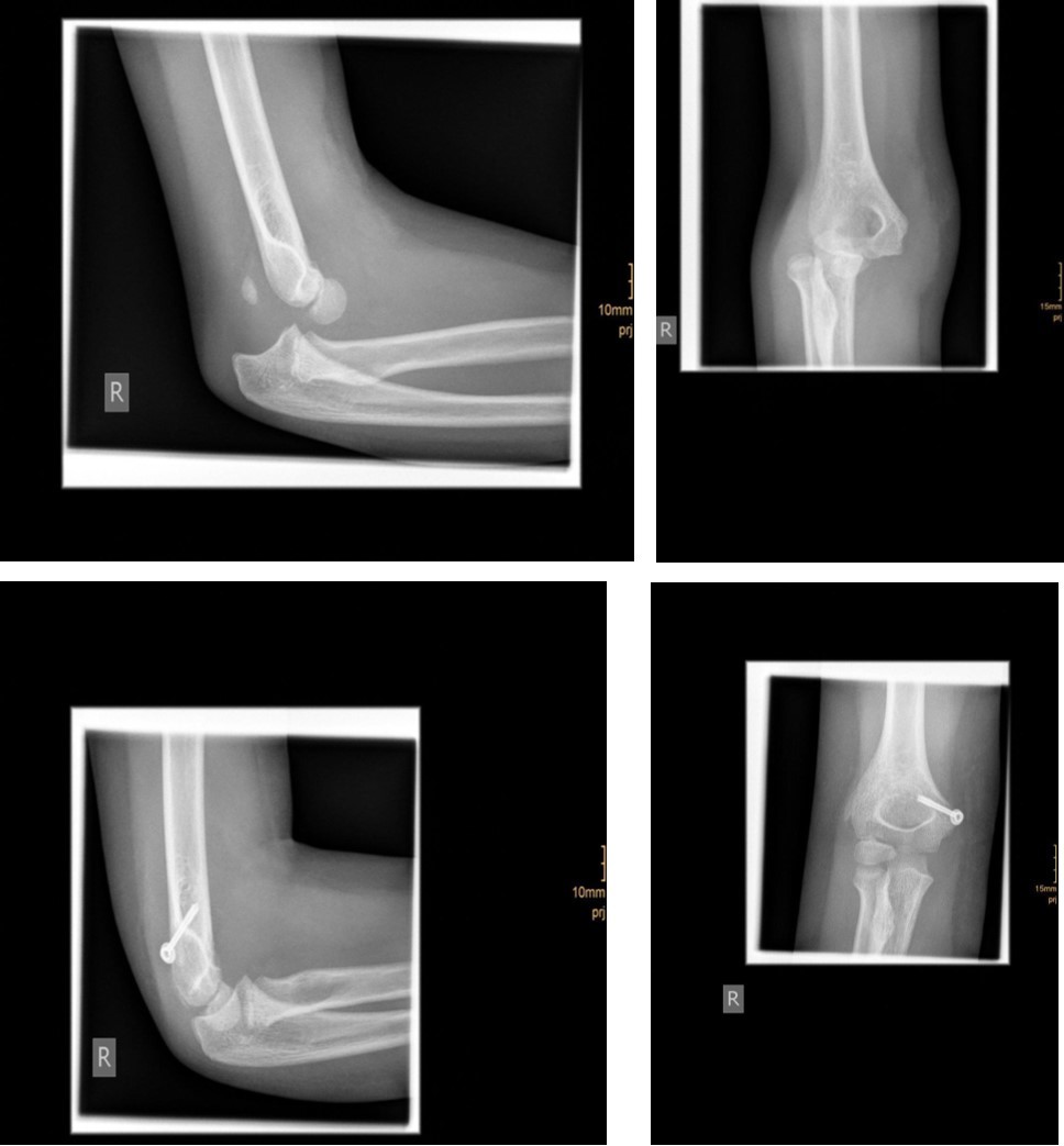 9 year old female patient with a elbow dislocation and a dislocated right medial condyle fracture which was treated by open reduction and osteosynthesis with a screw (personal collection)