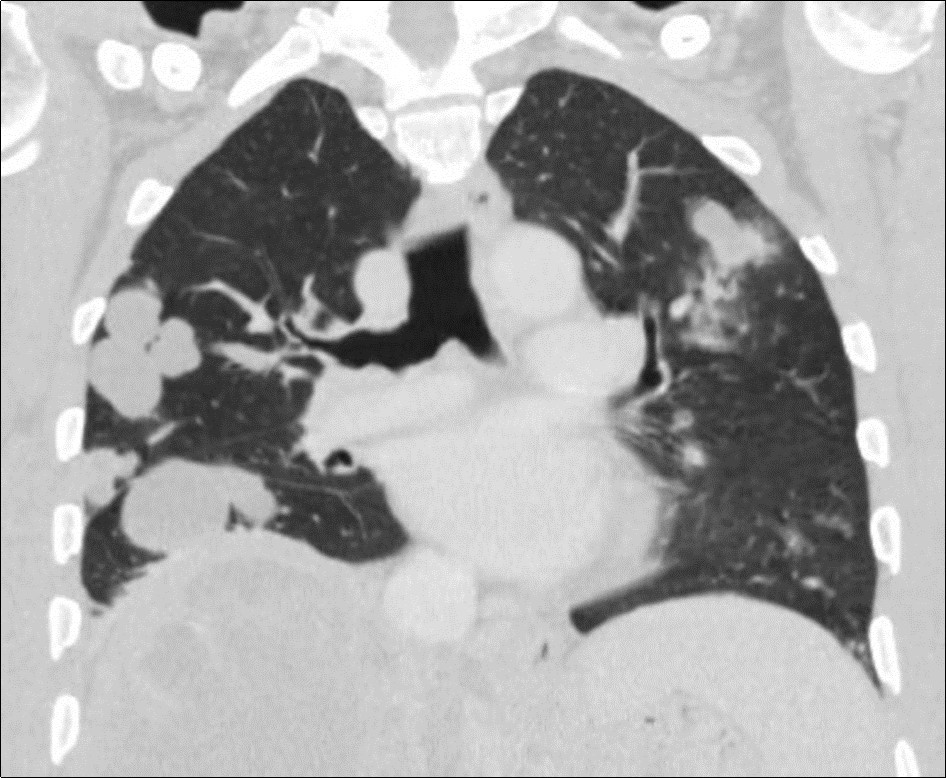 Coronal CT scan showing multiple bilateral pulmonary masses of both lungs associated with centrilobularmicronodules