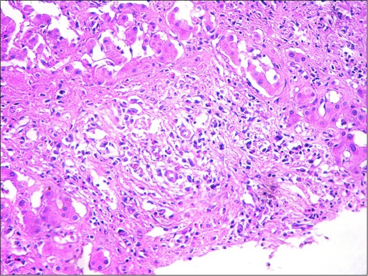 Hepatic biopsy showing a marked inflammatory reaction with a polymorphic infiltrate (HEx200)