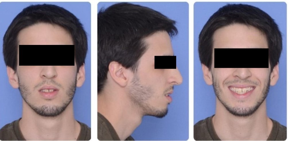 (a) Extraoral Frontal View (b) Extraoral Lateral View (c) Extraoral Smile View