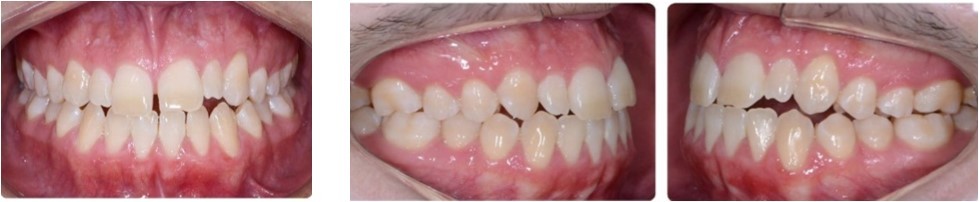 (a) Intraoral Anterior View (b) Right Intraoral View (c) Left Intraoral View