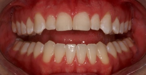 Minimally-invasive preparation