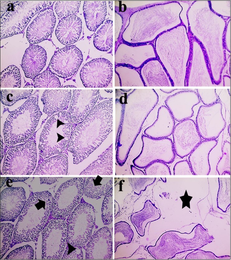 Sections from control group; the testes (a) and epididymis (b) display normal histological structures. In second group (BPA 10 μg/kg); testes (c) with arrowheads pointing to vacuolar degeneration in germinal epithelium lining some seminiferous tubules. While, epididymis (d) shows partial emptying epidydmal ducts. In third group (BPA 15 μg/kg); Testis (e) with arrowhead pointing to vacuolar degeneration in germinal epithelium lining some seminiferous tubules and arrows pointing to necrosis in germinal epithelium. Meanwhile, epididymis (f) with a star marking severe edema and widely separating epididymal ducts (X: 100).