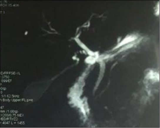 Magnetic resonance cholangiopancreatography showing multiple biliary strictures and parietal irregularities