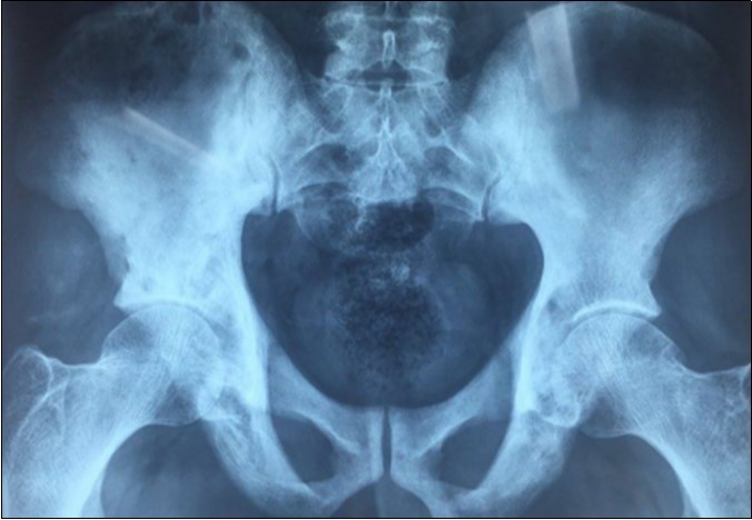X ray of the pelvis showing condensations with a fibrillar appearance and hypertrophy of the bone