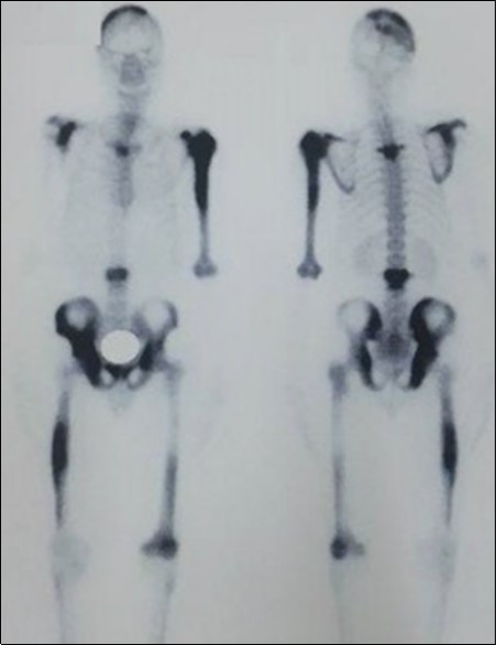 Bone scan mapping lesions showing a multifocal achievement of the bones