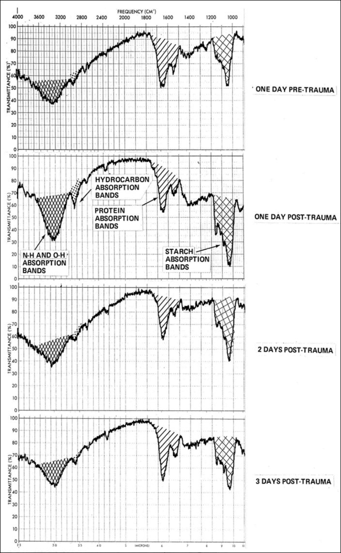Infrared (IR) spectral records showing the anomalous and rapid shift in protein-to-starch ratio in mucin following person’s physical trauma (car accident) and accepting medication.