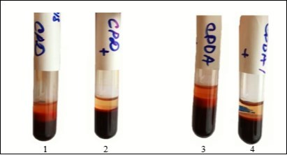 Visual assessment hemolysis of erythrocytes in various aspects of exposure at the stage VI.Notes: 1- RBC (preserving agent CPD) + 0.9% NaCl solution; 2 – RBCs (preserving agent CPD) + 0.9% NaCl solution which previously was processed by ICNB; 3- RBCs (preserving agent CPDA-1) + 0.9% NaCl solution; 4 - RBCs (preserving agent CPDA-1) + 0.9% NaCl solution which previously was processed by ICNB.