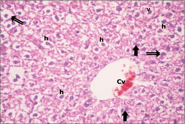 A photomicrograph of a section in the liver of ZnONPs-treated adult albino rat showing dilated congested central vein (Cv) and ballooning of hepatocytes (double arrows) with darkly-stained nuclei (h) and vacuolated cytoplasm (v). Binucleated cells are also seen (thick arrows). (H&E X400)