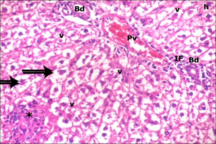 A photomicrograph of a section in the liver of ZnONPs-treated adult albino rat showing dilated congested portal vein (Pv), proliferation of bile duct (Bd), inflammatory cell infiltration (IF) and ballooning of hepatocytes (double arrows) with darkly-stained nuclei (h) and vacuolated cytoplasm (v). Area of necrotic focus is also present (star). (H&E X400)