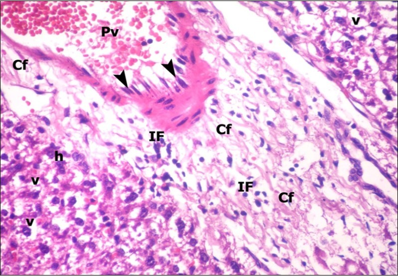 A photomicrograph of a section in the liver of ZnONPs-treated adult albino rat showing congested portal vein (Pv) with elongation of its endothelial lining (arrow head) and increasing amount of connective tissue fibers (Cf). Mononuclear cellular infiltration (IF) and hepatocytes with darkly-stained nuclei (h) and vacuolated cytoplasm (v) could be demonstrated. (H&E X400)