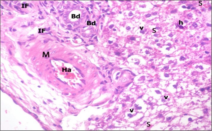 A photomicrograph of a section in the liver of ZnONPs-treated adult albino rat showing congested hepatic artery (Ha) with increasing thickness of its muscular layer (M) and proliferation of bile duct (Bd). Mononuclear cellular infiltration (IF), congested blood sinusoids (s) and hepatocytes with darkly-stained nuclei (h) and vacuolated cytoplasm (v) are also seen. (H&E X400)