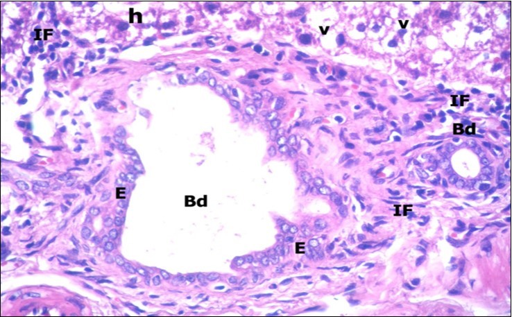 A photomicrograph of a section in the liver of ZnONPs-treated adult albino rat showing proliferation of bile duct (Bd) with stratification of its epithelial lining (E). Mononuclear cellular infiltration (IF) in the portal area and hepatocytes with darkly-stained nuclei (h) and vacuolated cytoplasm (v) are also seen. (H&E X400)