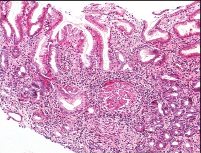 Histological aspect of gastric granulomatosis secondary to tuberculosis : Antral biopsy specimens revealing multiple necrotizing (caseating) granulomas ( HEx100)