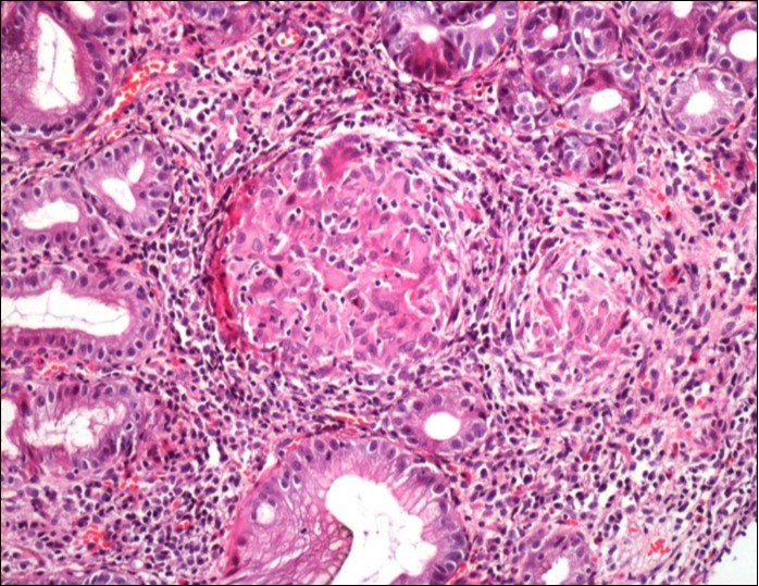 Histological aspect of gastric granulomatosis secondary to sarcoidosis : Antral biopsy specimens revealing multiple non-necrotizing (sarcoid-like) granulomas ( HEx200)
