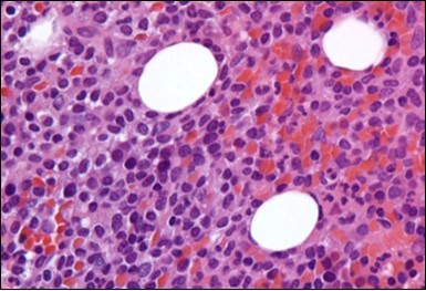 HCL: hairy cells infiltrating designated spaces(17).