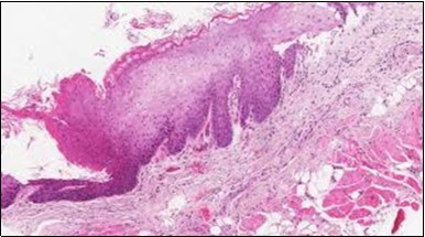 HCL Oral mucosa with soft tissue infiltration of hairy cells(27).