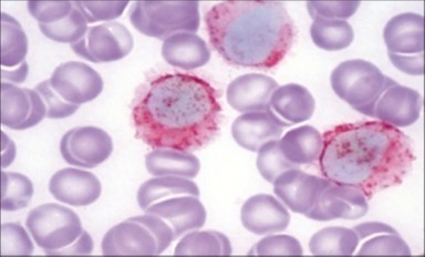 HCL: hairy cells with demonstrable tartrate resistant acidic phosphatise( TRAP) stain(29).