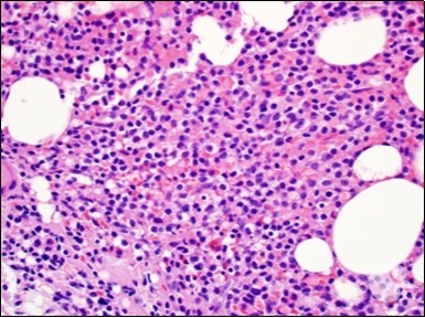 HCL: hairy cells dispersed within the native architecture(19).