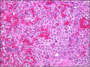 HCL: hairy cells with infiltration in the spleen(21).