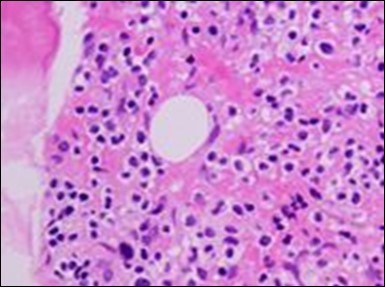 HCL: disseminated hairy cells with a clear cytoplasm(22).